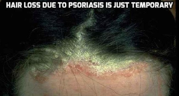 scalp psoriasis hair loss #10