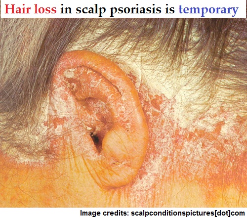 Getting to the Root of Scalp Psoriasis to Prevent Hair Loss
