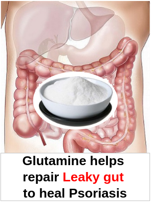 Leaky gut Psoriasis Glutamine